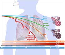 DPOC – Doença Pulmonar Obstrutiva Crônica. Infográfico para folheto, anúncio e material farmacêutico