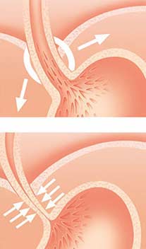 Refluxo gástrico. Detalhe do esfíncter do estomago, ilustração para folheto e anúncio de laboratório médico farmacêutico