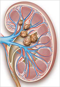 ilustrações médicas da formação de pedras nos rins para revista médica sobre saúde
