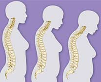 Osteoporose, imagem do processo de envelhecimento, ilustração para folheto, anúncio e catálogo